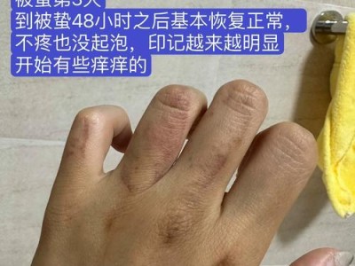 被水母蛰了会怎么样（水母蛰伤后的症状和应对方法）